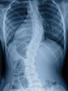 X-ray image of a human torso showing severe S-shaped scoliosis of the spine.